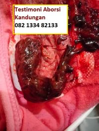 Obat Penggugur Kandungan ® WA.082133482133 Obat Aborsi Tanjungbalai