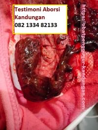 Obat Penggugur Kandungan ® WA.082133482133 Obat Aborsi Surabaya