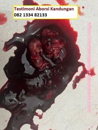 Obat Penggugur Kandungan ® WA.082133482133 OBAT ABORSI Asli JOGJA